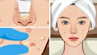 ASMR Pimple Popping and Blackhead Extraction Animation The Ultimate Skin Care Therapy [upl. by Melony556]