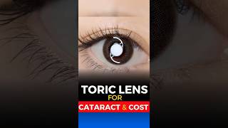 Toric Lens for Cataract Surgery Cost [upl. by Wrigley]