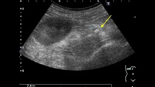 Ureteral Stones [upl. by Ludovico]