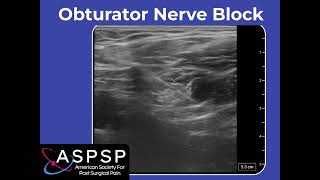 Ultrasound Guided Obturator Nerve Block [upl. by Welcome]