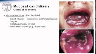 Candida Mucosal candidiasis [upl. by Ivor]