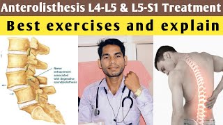 anterolisthesis l5 s1 treatment anterolisthesis grade 1 treatment exercises l4 l5 lumbar spine [upl. by Almond666]