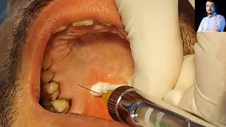 Local Anesthesia Greater Palatine Nerve Block Technique Maxillary anesthesia Techniques dentistry [upl. by Atnad]