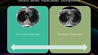 Thymoma [upl. by Harcourt]