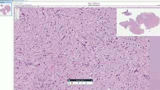 Rosenthal fibers in Pilocytic Astrocytoma  Adventures in Neuropathology [upl. by Esilanna]