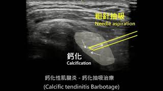 Supraspinatus calcific tendinitis ultrasoundguided barbotage 肩膀鈣化性肌腱炎鈣化抽吸治療 [upl. by Currey73]