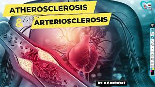 Arteriosclerosis and Atherosclerosis part 1 WITH EASY NOTES  EXPLANATION IN HINDI  NG MEDICALS [upl. by Frieda801]