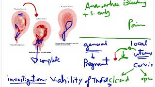 Abortion 2 quot Threatened abortion and its fates quot [upl. by Margarethe]