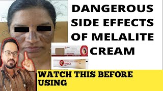 Melalite Cream Review  इस क्रीम का इस्तेमाल ना करें [upl. by Gilud]