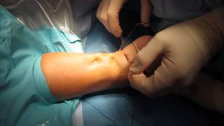 Percutaneous Achilles Tendon Surgery Repair Unedited by Kevin R Stone MD [upl. by Orecic184]