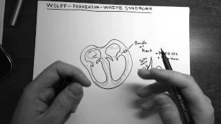 WolffParkinsonWhite Syndrome [upl. by Pulling753]