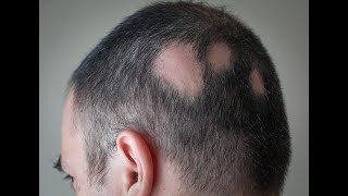 Alopecia areata Treatment  Intralesional Corticosteroid InjectionBy Dr sunny Rajput [upl. by Hobbie643]