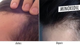 Minoxidil Antes e Depois tratamento contra calvicie [upl. by Adnovahs]