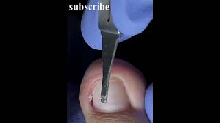 Best Satisfying Ingrown Toenail Removal [upl. by Ellenuahs221]