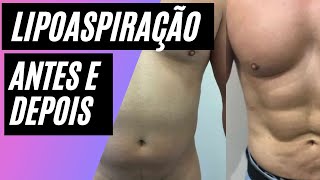 LIPOASPIRAÇÃO Antes e depois [upl. by Ayoj]