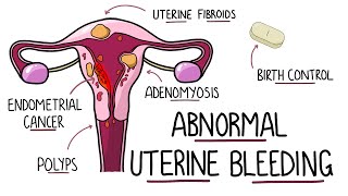 How is rectal bleeding diagnosed [upl. by Aihtekal]