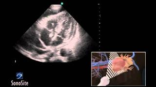 How To Ultrasound Guided Pericardiocentesis Procedure 3D Video [upl. by Casimire100]