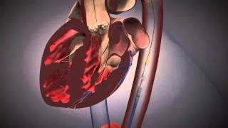 Cardiologie  TAVI Procedure EdwardsXT [upl. by Ailemac]