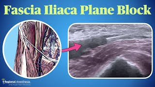 Fascia Iliaca Plane Block [upl. by Eseela]