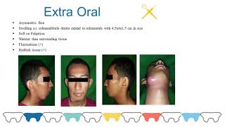 MANAGEMENT OF ABSCESS IN PATIENT WITH ODONTOGENIC INFECTIONS [upl. by Bridie284]