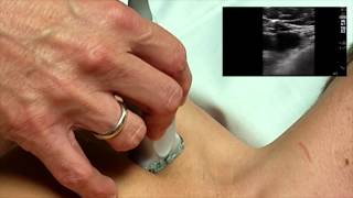 Ultrasound Guided Subclavian Line [upl. by Malilliw]