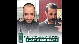 Our FDAapproved Alika Hair Restoration System [upl. by Bergh]