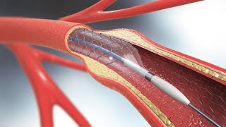 Biology for Engineers Module 2 Designs of Stents [upl. by Hairabez748]