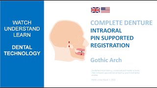 Intraoral pinsupported registration according Prof GERBER [upl. by Reizarf]