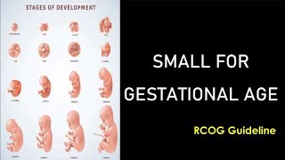 Small for Gestational Age RCOG guideline [upl. by Karas819]