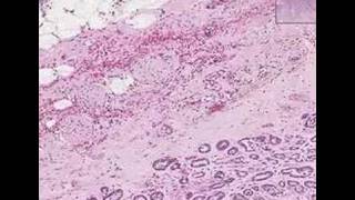 Histopathology Prostate Adenocarcinoma Gleason grade 3 [upl. by Laforge]