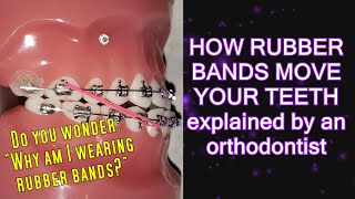 How elastics  rubber bands move teeth time lapse  Braces Explained [upl. by Valery]