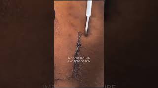 Best Pimple Pop Videos Blackheads Acne Cyst Popping Ingrown Hair Removal [upl. by Gnuh177]