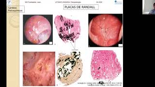 2020 05 Uncoma Litiasis urinaria Cólico Renal [upl. by Lynch553]