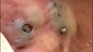 Popping Giant Pimple ampamp Popping Huge Blackheads  Best Pimple Popping Video 7 [upl. by Kreis852]