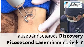 ลบรอยสักด้วยเทคนิคโปรแกรม Discovery Pico Laser Scar มีเทคนิคอย่างไร [upl. by Yngiram585]