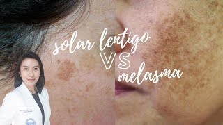 Whats the difference Solar Lentigo vs Melasma [upl. by Ahc154]