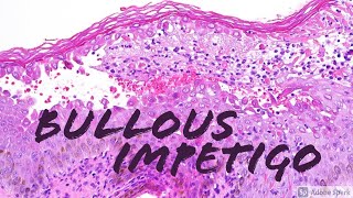 Bullous Impetigo vs Staphylococcal Scalded Skin SSSS 5Minute Pathology Pearls [upl. by Eimilb]