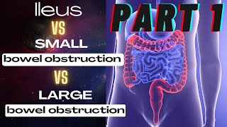 GENERAL SURGERY Small bowel obstruction vs large bowel obstruction vs Ileus [upl. by Grati]