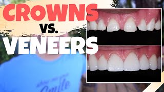 Dental CROWNS vs Porcelain VENEERS  Is the Dental Veneers Procedure Worth It [upl. by Hserus]