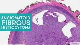 Angiomatoid Fibrous Histiocytoma 101 Note its NOT aneurysmal dermatofibroma [upl. by Aubine]