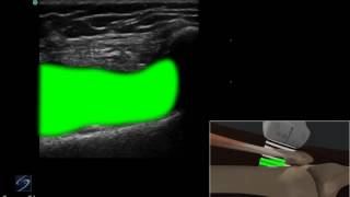 How to Ultrasound Guided Injection of the Lateral Knee 3D Video [upl. by Attenauq]