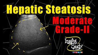 Moderate Hepatic Steatosis  Moderate Fatty Infiltration  Ultrasound  Case 171 [upl. by Yffat]