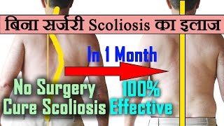 Scoliosis100 Effective Scoliosis Treatment Exercises At Homeस्कोलियोसिस का बिना सर्जरी इलाज [upl. by Brittney73]