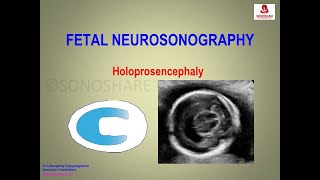 Fetal Neurosonography – Holoprosencephaly [upl. by Haiel962]