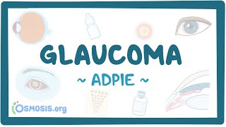 Glaucoma Nursing Process [upl. by Lipman]