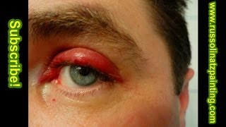 Chalazion Surgery [upl. by Assilim]