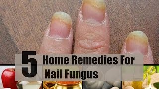 5 Home Remedies For Nail Fungus [upl. by Suzanne392]