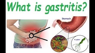 What is gastritis Causes and symptoms of gastritis [upl. by Carin283]