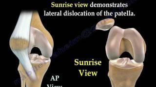 Patellar Dislocations  Everything You Need To Know  Dr Nabil Ebraheim [upl. by Yart369]