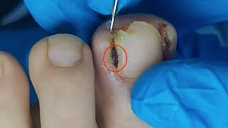 【Daily Pedicure Tutorial】Removing Deeply Embedded Ingrown Toenails on Both Sides of The Big Toe [upl. by Eet34]